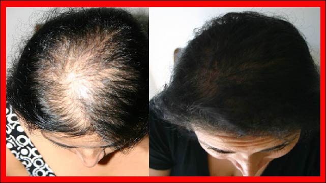 الصلع المبكر أمر خطير جدا ! أسرع لتجعل شعرك أكثر كثافة