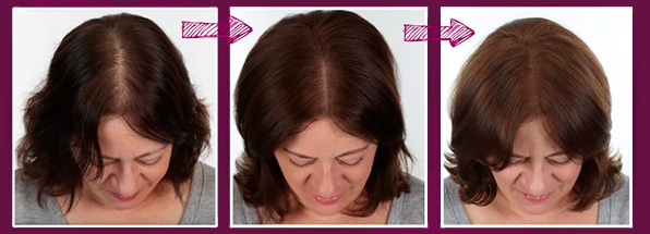 انس تساقط الشعر والصلع ..  ستعيد إنبات شعرك من جديد