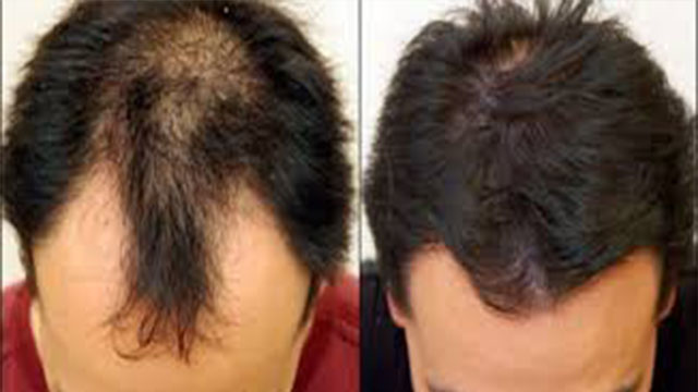 أسرع الطرق لعلاج الصلع المبكر ونمو الشعر بكثافة